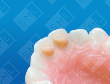 Incisal Blocks image 1