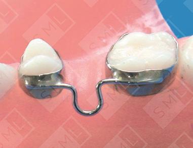 Adjustable Two-Band Interim Bridge