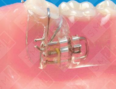 Removable Uprighting Partial U/L image 3