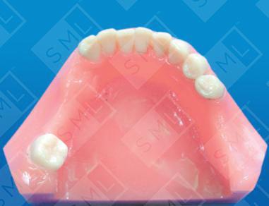 Removable Uprighting Partial U/L image 2