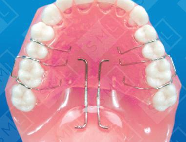 Soft Palatal Lift Appliance image 1