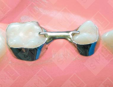 Two-Band Interim Bridge with Occlusal Bar U/L