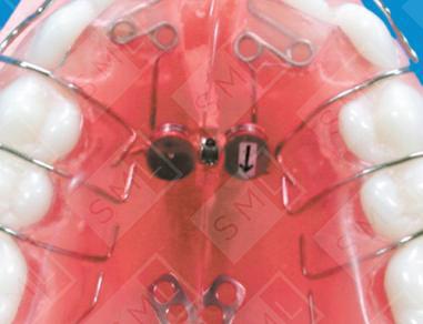 Swing Lock Expander