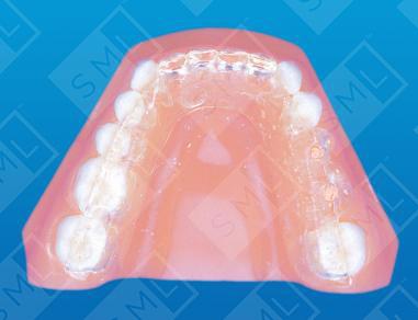 CT Scan Appliance for the Partially Edentulous Patient image 1