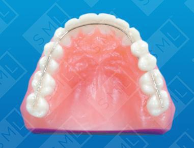 Intra-Coronal Splint w/Pontics image 1