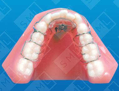Lower Schwarz Adult Dentition with "C" Clasps on the Bicuspids image 1