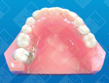 Removable Uprighting Partial U/L image 1