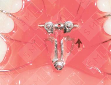 Wipla Expansion Screw image 1