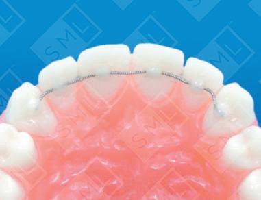 E-Z Bond Lingual Retainer 