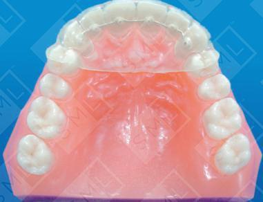 E-Z bond lingual retainer 