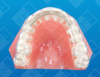maxillary horseshoe splint