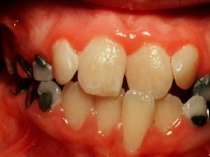 Bad Teeth