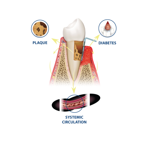 Plaque Diabetes
